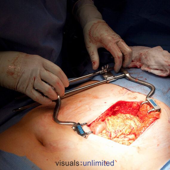 left subcostal incision showing omentum, exposed w/Balfour retractor